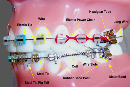 illustration of braces